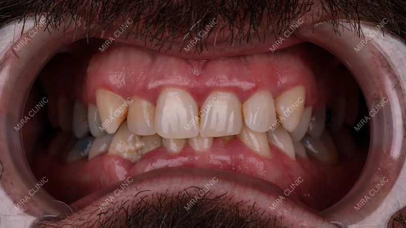 before zirconium crowns